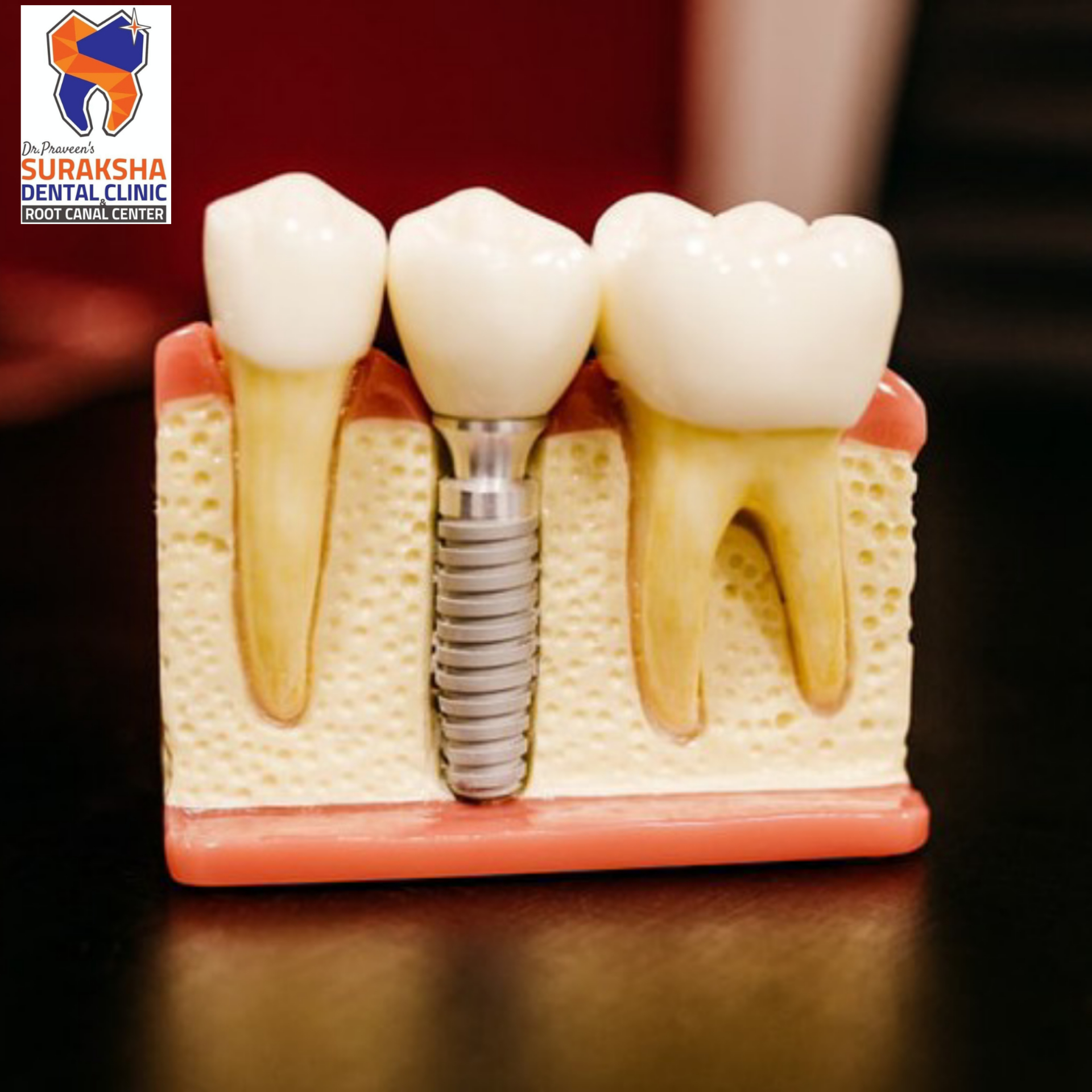 dental implants for missing teeth replacement.