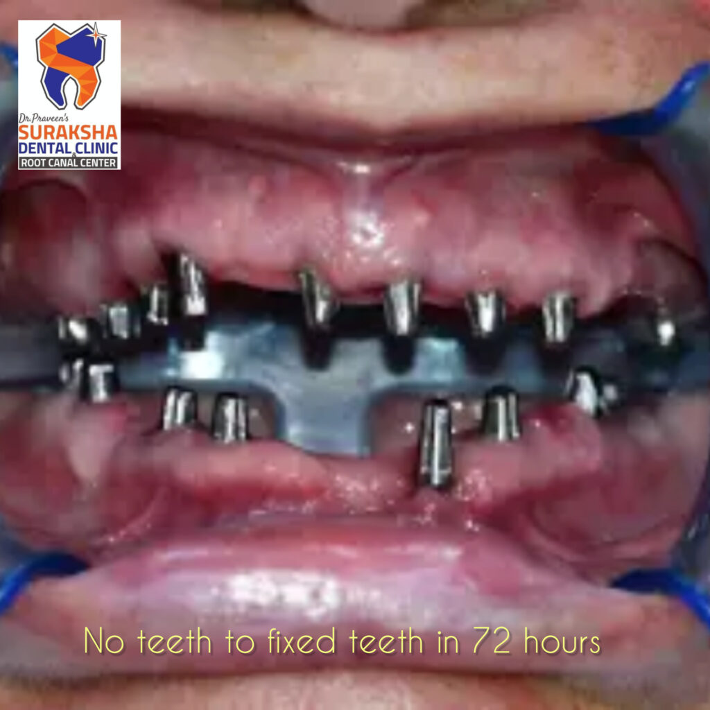 full mouth dental implants in guntur. Dental implants for fixed teeth. now get the longterm solution for ,issing teeth with dental implants at suraksha dental guntur