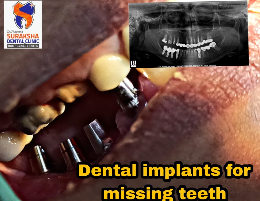 dental implants in guntur 