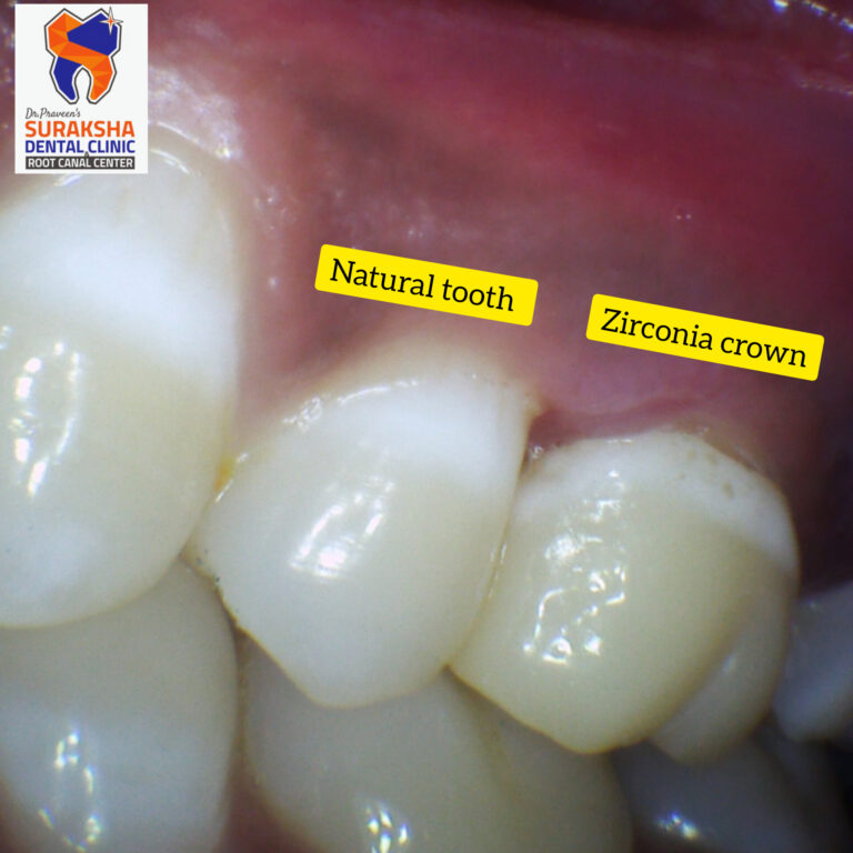 dental caps