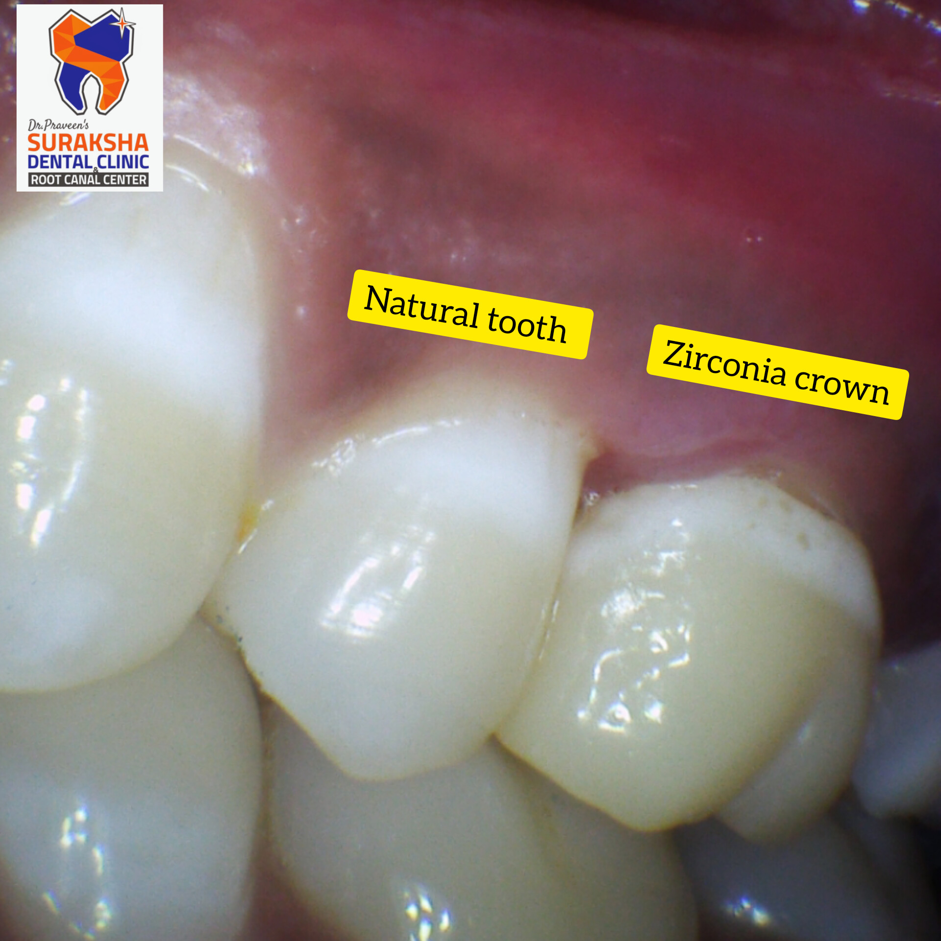 “Dental Crowns Demystified: 10 FAQs Answered by Experts at Suraksha Dental Clinic in Guntur”