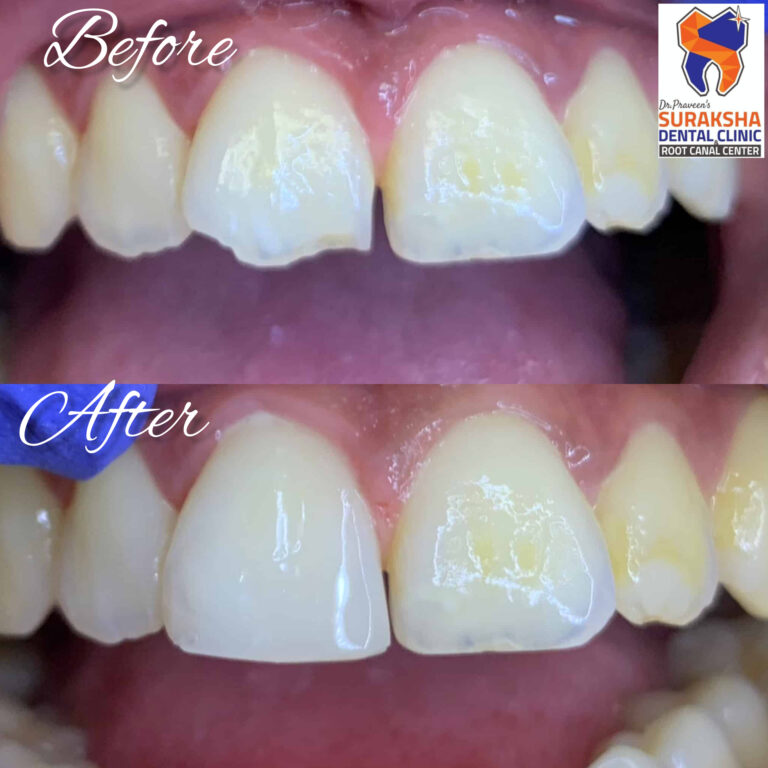 Composite Bonding in Guntur